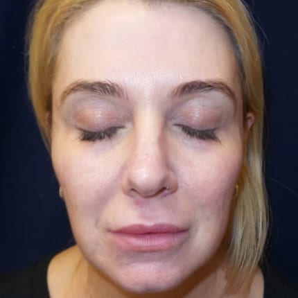 pinski voluma juvederm 1 after