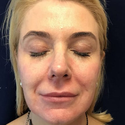 pinski voluma juvederm 1 before