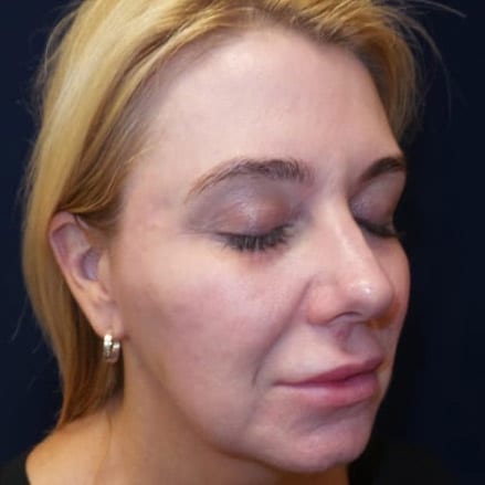 pinski voluma juvederm 2 after