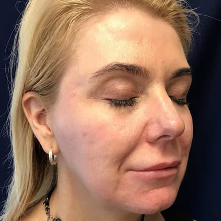 pinski voluma juvederm 2 before