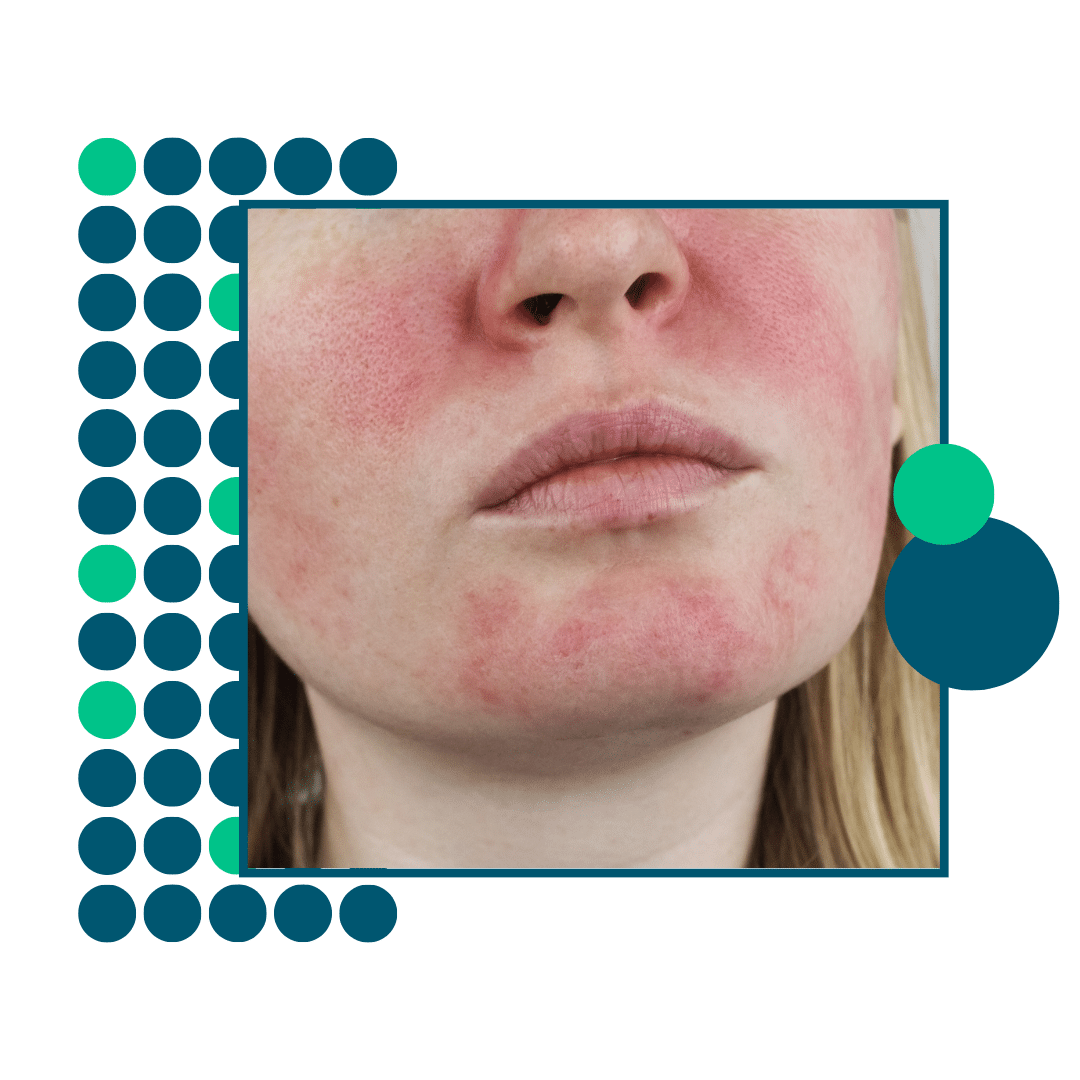 rosacea feature