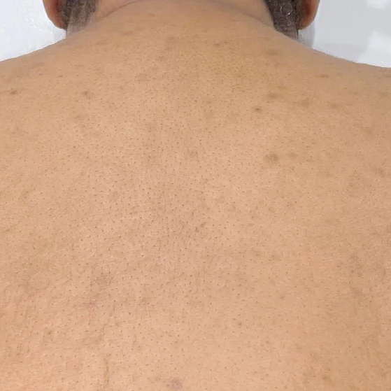 vi body peel after 2