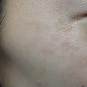 Bucktown After VARILITE TREATMENT FOR BROWN SPOTS