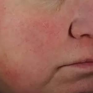 Bucktown Before LIMELIGHT TREATMENT FOR ROSACEA