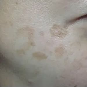 Bucktown Before VARILITE TREATMENT FOR BROWN SPOTS