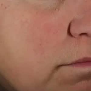 Bucktown LIMELIGHT TREATMENT FOR ROSACEA AFTER THREE TREATMENTS