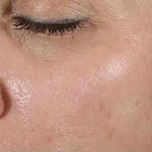 Bucktown MICROPEN LIMELIGHT FOR BROWN SPOTS AFTER THREE TREATMENTS