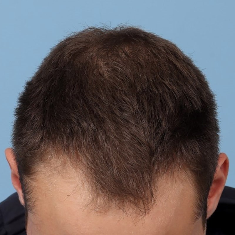 bucktown PRP for Alopecia After 3 treatments