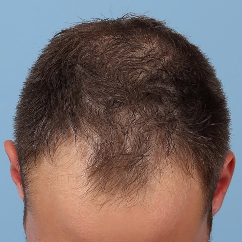 bucktown PRP for Alopecia Before 3 treatments
