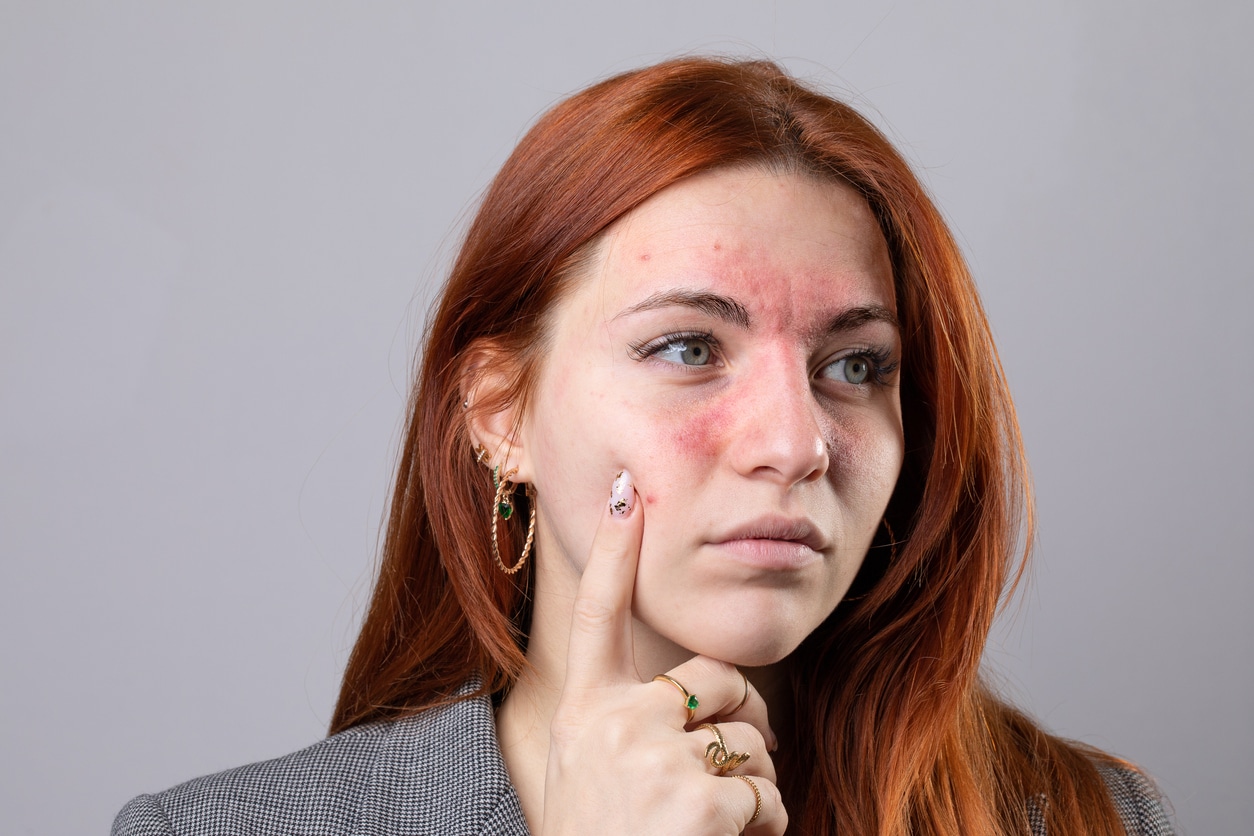 Young woman suffering from rosacea.