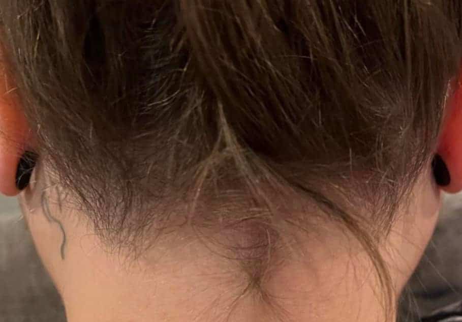 pinski alopecia after treatment