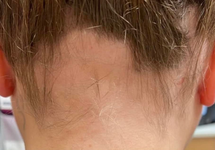 pinski alopecia before treatment
