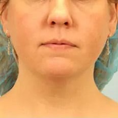 Bucktown KYBELLA AFTER 6 WEEKS OF TREATMENT
