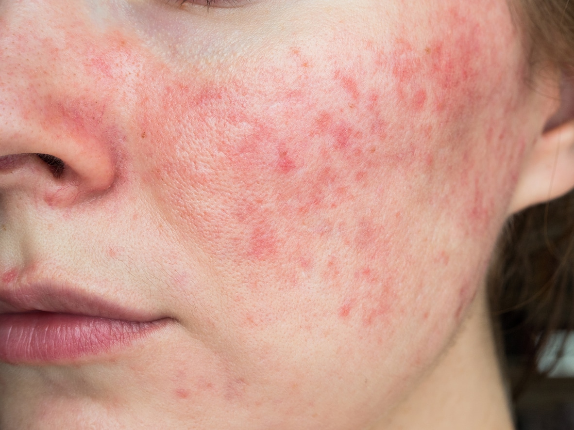 Closeup of the cheek of a women with blotchy, red skin due to skin irritation