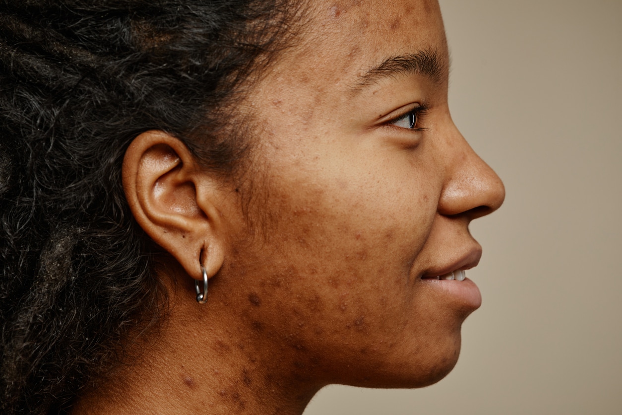 Closeup of a black women and her facial hyperpigmentation due to acne scars