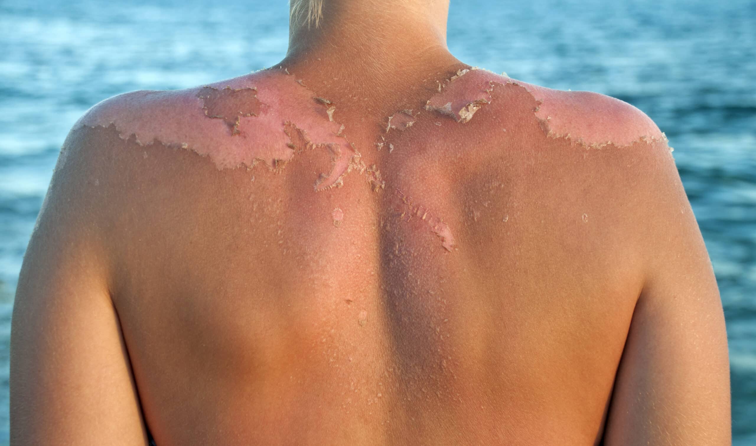 Peeling sunburned back