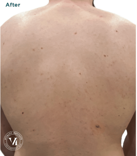 After VI Peel 2